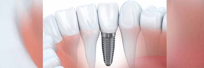 Illustration einer Zahnreihe mit Implantat und Krone
