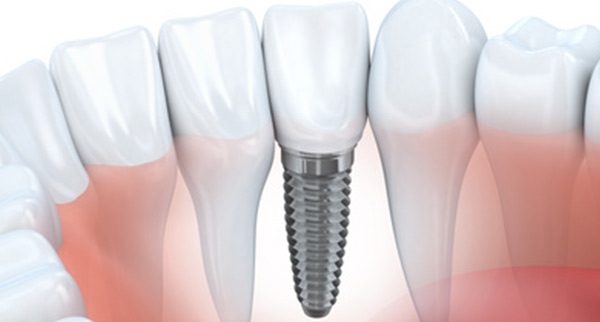Illustration einer Zahnreihe mit Implantat und Krone